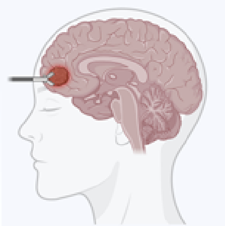 tumorid.png